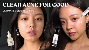 Acne Clearer Skin