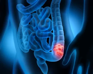 Colorectal Cancer Under 50