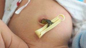 Umbilical Cord Innovation