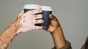 Vitiligo Prevention