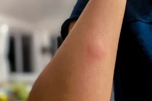 Mosquito Bites