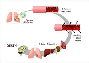 Sepsis