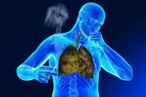  Lung Diseases