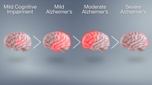 Alzheimer's Disease