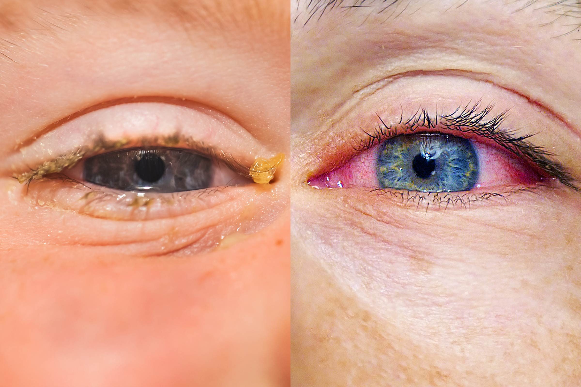 Pink Eye vs. Dry Eye