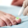What to Know About Laser Treatment For Toenail Fungus