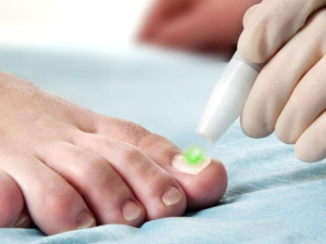 What to Know About Laser Treatment For Toenail Fungus
