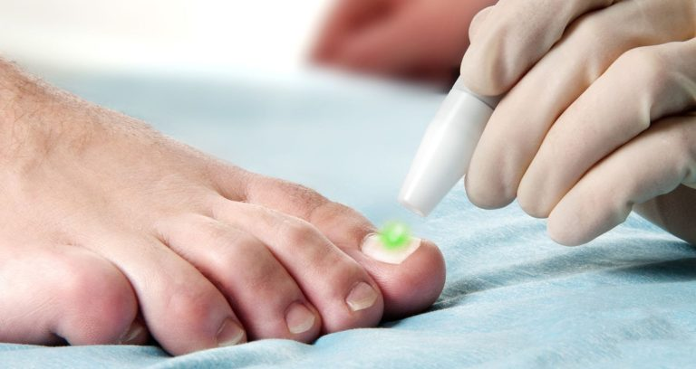 What to Know About Laser Treatment For Toenail Fungus