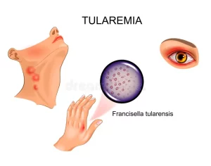 Tularemia