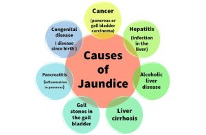 Causes of Jaundice