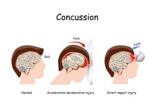 Concussion