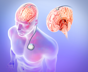 Deep Brain Stimulation