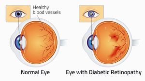 Eyes and Aging