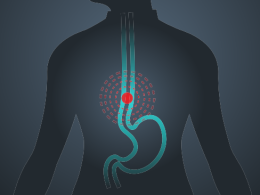 Esophageal Cancer