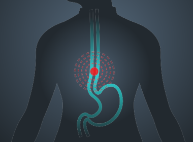 Esophageal Cancer