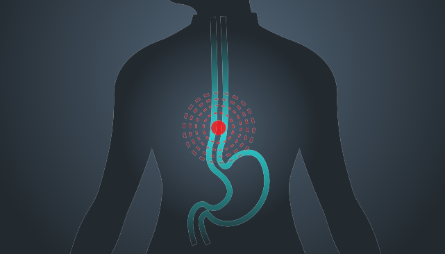 Esophageal Cancer