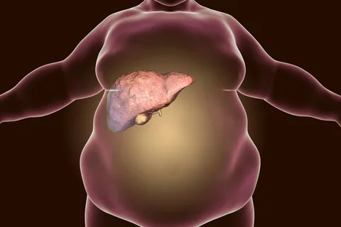 Fatty Liver