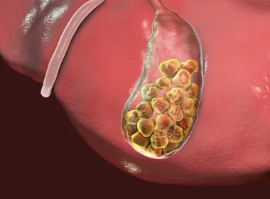 Gallstones