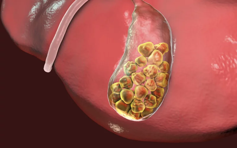 Gallstones