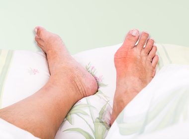 Gout Flare-Ups