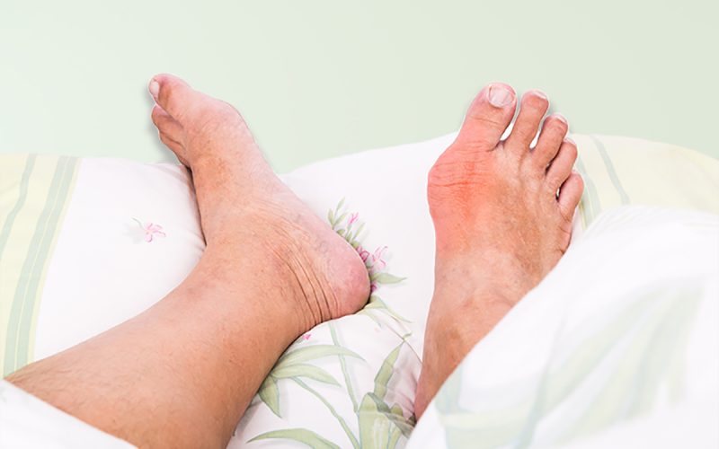 Gout Flare-Ups