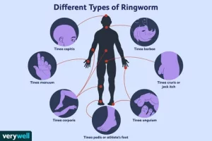 Ringworm 