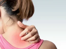 Spotting Heat Rash