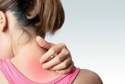 Spotting Heat Rash