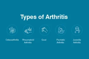 Arthritis