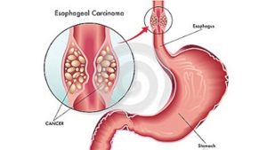 Esophageal Cancer