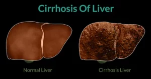 Gallstones 