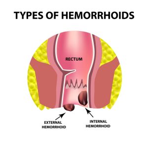 Hemorrhoid Pain