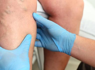 Vein Clinic Oakbrook