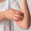 Discoid Lupus