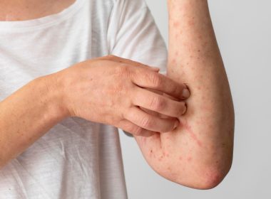 Discoid Lupus