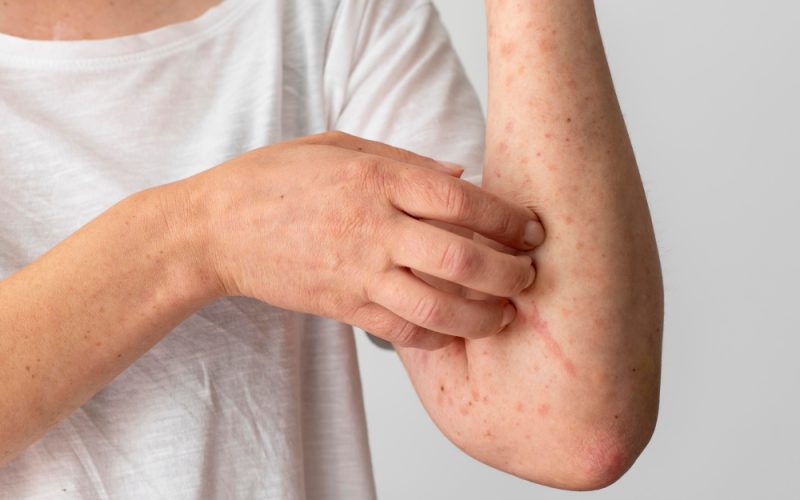 Discoid Lupus