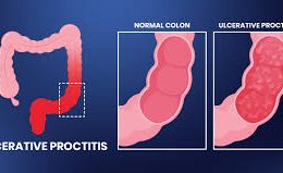 Ulcerative Proctitis vs Colitis