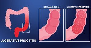 Ulcerative Proctitis vs Colitis