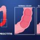 Ulcerative Proctitis vs Colitis