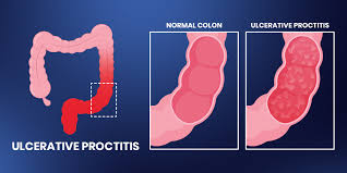 Ulcerative Proctitis vs Colitis