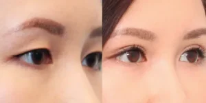 eyelid surgery