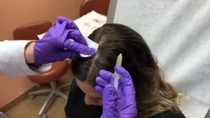 Hair Restoration