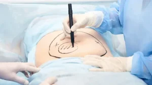 liposuction in Riyadh