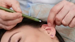 Ear Reshaping Surgery