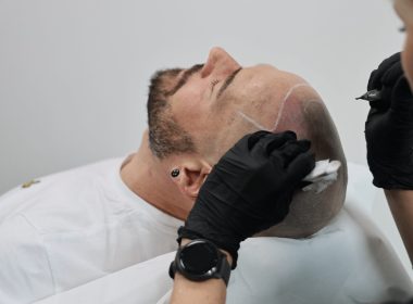 Scalp Micropigmentation Dubai