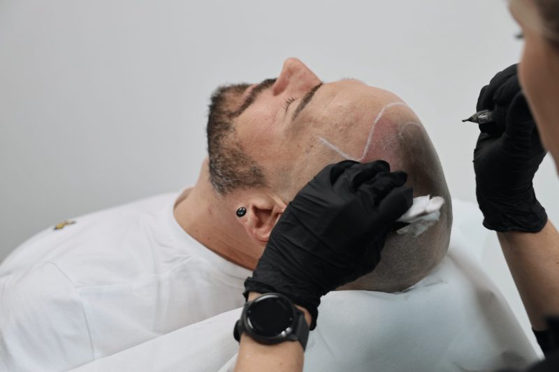 Scalp Micropigmentation Dubai